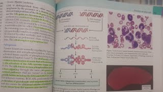 Chronic Myeloid Leukemia  SPECIAL PATHOLOGY [upl. by Akelam]