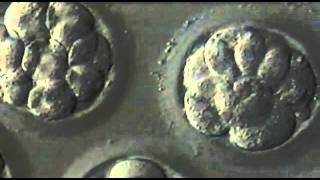 5Day Blastocyst Transfer [upl. by Acsehcnarf]