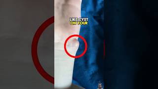 Remove This Dangerous Cyst At Home😨 shorts [upl. by Nuncia]