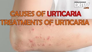 What causes Urticaria  Treatment of Urticaria  Types of Urticaria [upl. by Sondra]