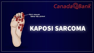 Kaposi Sarcoma [upl. by Astra]