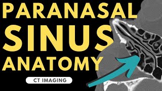 Paranasal Sinuses and Nasal Cavity  Radiology anatomy part 1 prep  CT imaging [upl. by Grew332]