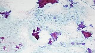 Pleomorphic adenoma Cytology [upl. by Terpstra424]