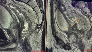 Cáncer de recto evaluación con resonancia magnética de 3 Teslas [upl. by Memberg]