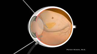 Posterior Vitreous Detachment PVD and Retinal Detachment RD [upl. by Lecrad417]