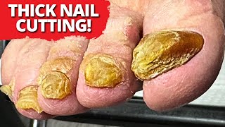 Cutting Thick Yellow Toenails – You Won’t Believe the Before and After [upl. by Mis]