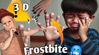 FROSTBITE शीतदंशहिमदाहतुषारदंश3D ANIMATION [upl. by Eenaffit874]