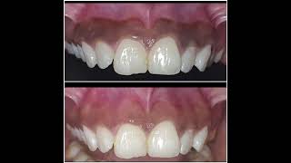 Gingival Depigmentation using scalpel [upl. by Eirena]