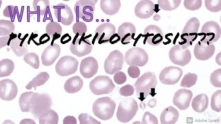 What is Pyropoikilocytosis Peripheral Blood Smears with Dr Jeanette Ramos [upl. by Etnod]