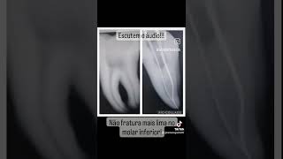 Nunca mais fratura Lima na mesial de molar inferior [upl. by Ahsilyt]