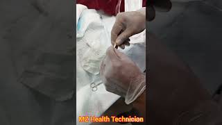 PCN Catheter how to Connected Percutaneous Nephrostomy Catheter with Urine bag without connector [upl. by Dud]