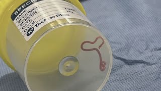 Parasitic worm found in womans brain [upl. by Nwahsid]