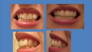 INVISALIGN Update Tray 21 last tray amp Refinements [upl. by Nniroc]