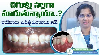 చిగుళ్లు నల్లగా మారుతున్నాయా  What is Gingival Depigmentation  Black Gums  Expert Dental Care [upl. by Aleek]