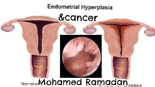 Endometrial hyperplasia amp endometria cancer by Dr M Ramadan [upl. by Yrrad]