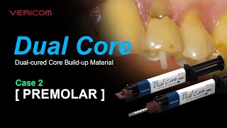 Dual Cured Core Build up Material Premolar 2 [upl. by Redd679]