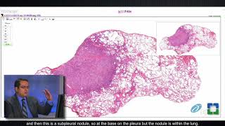 Pathology Insights Lung Granulomas Caused by Fungal Infection with Sanjay Mukhopadhyay MD [upl. by Lubbock]