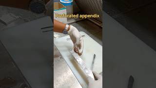 Appendix specimen grossing [upl. by Kamillah]