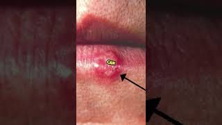 what the sign of herpes hsv information [upl. by Francyne]