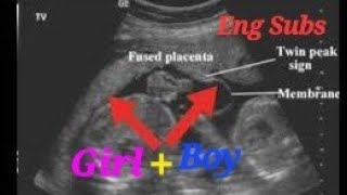 Anterior placenta means baby boy or girl  Anterior placenta baby gender  Boy n Girl Twin Pregnancy [upl. by Mighell]