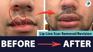 Lip Scar Revision  Lip Scar Before After Results  Lip Line Scar Removal  Lip Line Scar Revision [upl. by Haslett]