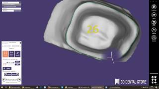 exocad  detection et modification de limite [upl. by Ilrahc]