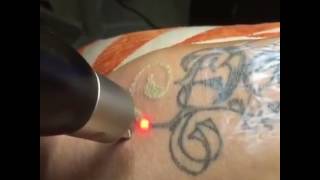 PicoSureTattooRemoval [upl. by Yraillih]