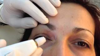 Not Surgical aesthetic blepharoplasty with PLEXR [upl. by Aleirbag]