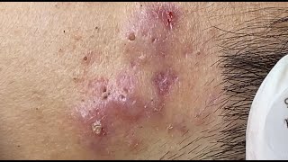 Hematoma Inflammation Acne HoangMySpa87 [upl. by Rocray]