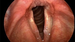 Laryngitis  a patient education video [upl. by Marilee]