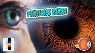 Phthisis bulbi  Your EYEBALLS  EYNTK 👁️👁️💉😳💊🔊💯✅ [upl. by Nylitak]