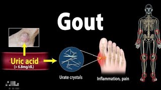 Gout Pathophysiology Causes Symptoms Risk Factors Diagnosis And Treatment Animation [upl. by Natlus257]