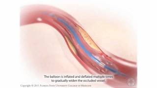 Percutaneous Coronary Intervention Coronary Angioplasty [upl. by Newmann]