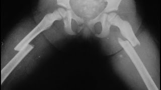 Atypical Femur Fractures and Bisphosphonates [upl. by Nedyah]