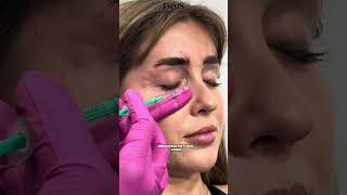 Full Face Botulinum Toxin Injection by Expert Doctor Prepare to Be Amazed [upl. by Viv300]