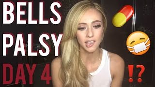 Bells Palsy Recovery and Home Remedies Ive been trying  Day 4 [upl. by Denby]