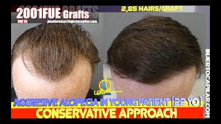 2001Grafts Conservative strategy in young patient waggresive alopecia 285 hg 29342023 [upl. by Shamma853]