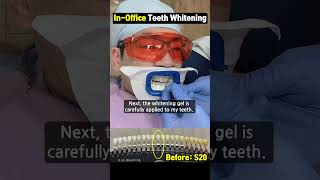 Venus White MAX teeth whitening [upl. by Atterg]