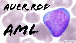 Acute Myeloid Leukemia Auer Rod in a Blast on Peripheral Blood Smear Hematopathology amp Hematology [upl. by Atinwahs]