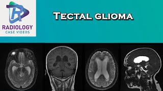 Tectal glioma [upl. by Aubreir]