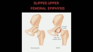 🍁 Slipped Upper Femoral Epiphysis  SUFE Key Points 🍁 [upl. by Gotcher]