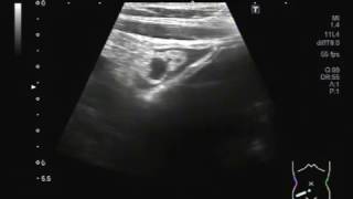 Ultrasound Video showing Intestinal Obstruction with Perforation [upl. by Adihahs]