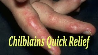 CHILBLAINS QUICK RELIEF  EASY HOME REMEDY FOR CHILBLAINS  CURE FOR बिवाई PERNIOSIS [upl. by Ferro514]