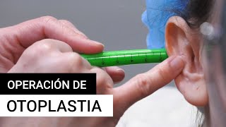 Operación de otoplastia  CEME [upl. by Aiz]