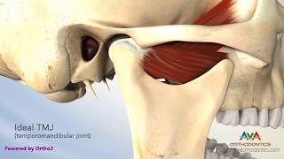 TMJ Disorder or TMD  Clicking and Closed Lock [upl. by Arriec]