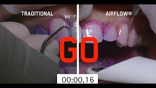 Abrasive teeth cleaning method vs AIRFLOW method [upl. by Thun580]