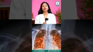 What is Occupational Asthma  Occupational Asthma in Hindi  SRIAAS doctor asthmaattack shorts [upl. by Parry403]