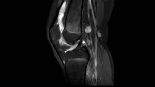 Septic arthritis of knee joint infection [upl. by Joline]