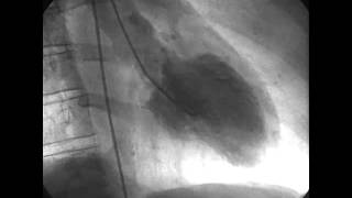 Procedural Coronary Angiography of Coronary Artery Thrombus Aspiration Followed by Bolus Intracorona [upl. by Talanta]