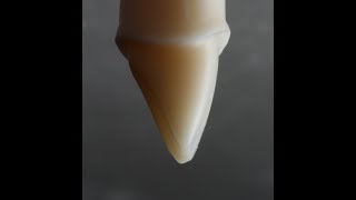 All Ceramic Crown Preparation for Emax and Zirconia [upl. by Alebasi]